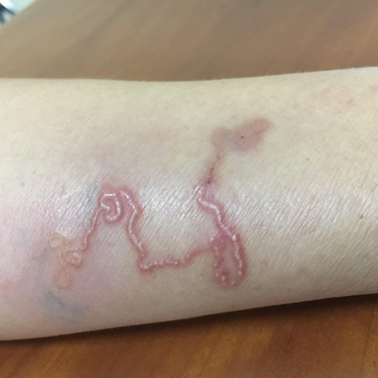 GÓI XÉT NGHIỆM GIUN SÁN